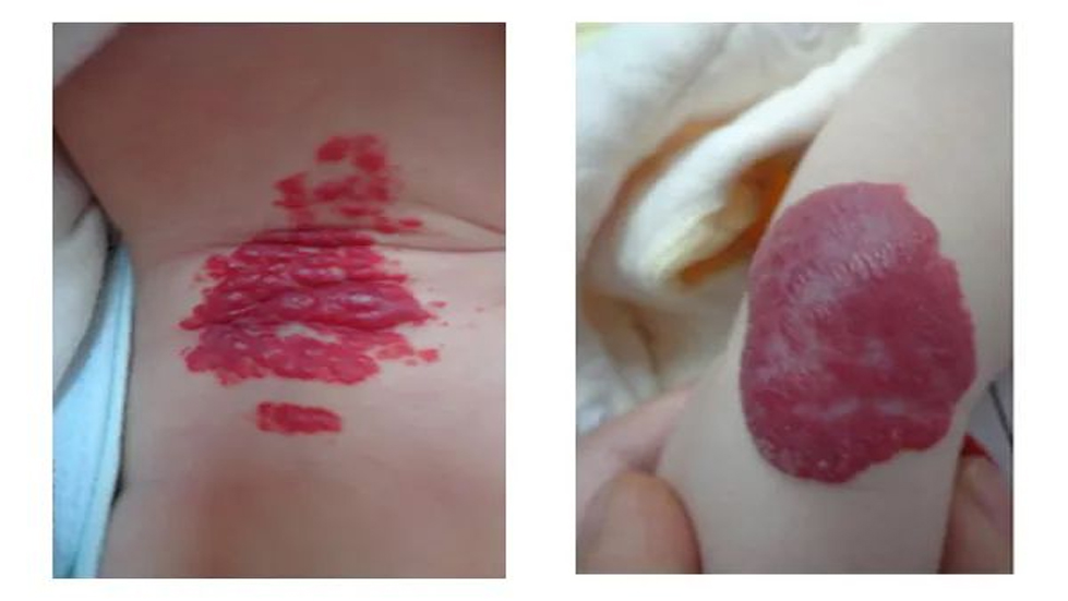 “红胎记”or婴幼儿血管瘤？